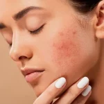 Ways to Get Rid of Acne Naturally and Effectively for Healthy and Clean Skin