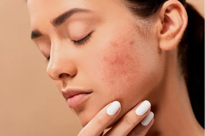 10 Ways to Get Rid of Acne Naturally and Effectively for Healthy and Clean Skin